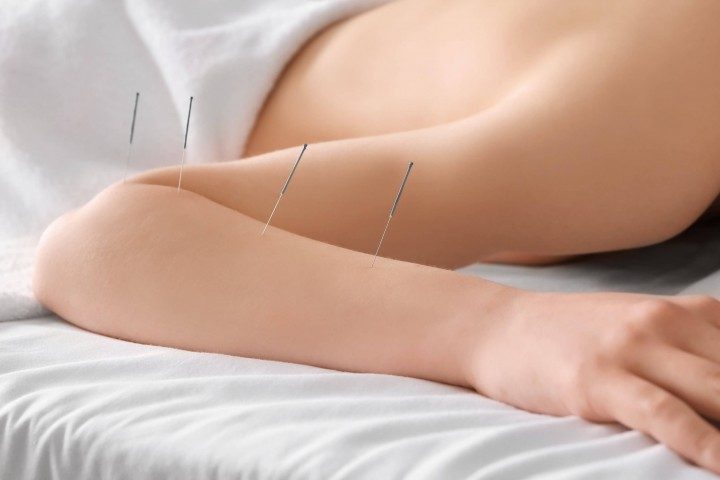 Acupunture in Brampton